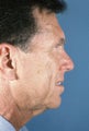 Facelift for Men