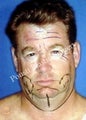 Face Lift