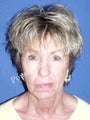 Face Lift, Forehead Lift, Neck Lift