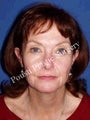 Eyelid Surgery (Blepharoplasty), Face Lift