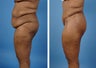 Lower Body Lift with Laser Liposuction to the Hips and Thighs