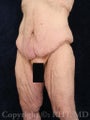 Lower body lift; medial thigh lift