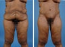 Lower Body Lift with Laser Liposuction to the Hips and Thighs