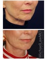 Lower Face and Neck Lift