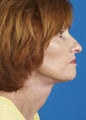 Lower Face Lift