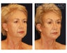 Facial Rejuvenation