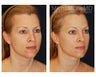Lower Face and Neck Lift