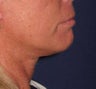 Lower Facelift and Neck Lift