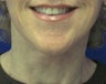 Lower Facelift and Neck Lift