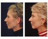 Lower Face and Neck Lift
