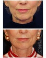 Lower Face and Neck Lift