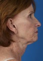 Lower Face Lift