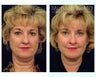 Lower Face and Neck Lift