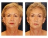 Facial Rejuvenation