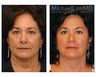 Facial Rejuvenation - Lower Face Lift