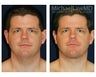 Lower Face and Neck Lift