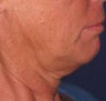 Lower Facelift and Neck Lift