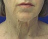 Lower Facelift and Neck Lift