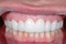 Combination Invisalign and Lumineers