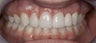 Porcelain Bridge and Veneers