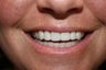 Veneers 