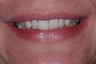 Combination Invisalign and Lumineers