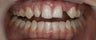 Porcelain Bridge and Veneers
