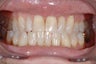 Lumineers Dental Veneers