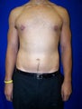 Gynecomastia