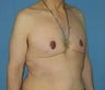 Male Chest Reduction