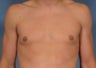Male Breast Reduction