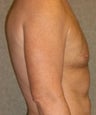Male Breast Reduction (Gynecomastia)