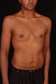 Male Breast Reduction