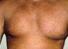 Gynecomastia and Power Assisted Liposuction