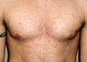 Gynecomastia and Power Assisted Liposuction