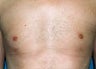 Gynecomastia and Power Assisted Liposuction