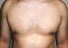 Gynecomastia and Power Assisted Liposuction