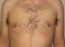 Gynecomastia and Power Assisted Liposuction