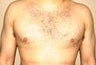 Gynecomastia and Power Assisted Liposuction