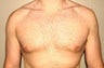 Gynecomastia and Power Assisted Liposuction
