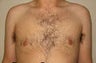 Gynecomastia and Power Assisted Liposuction