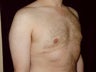 Gynecomastia Reduction Surgery