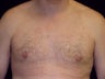 Gynecomastia Reduction Surgery