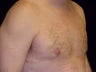 Gynecomastia Reduction Surgery