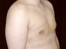 Gynecomastia Reduction Surgery