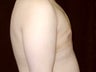 Gynecomastia Reduction Surgery