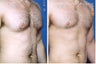 Male Breast Reduction Using Liposuction
