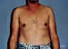 Male Breast Reduction