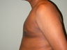 Gynecomastia