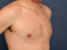 Gynecomastia correction
